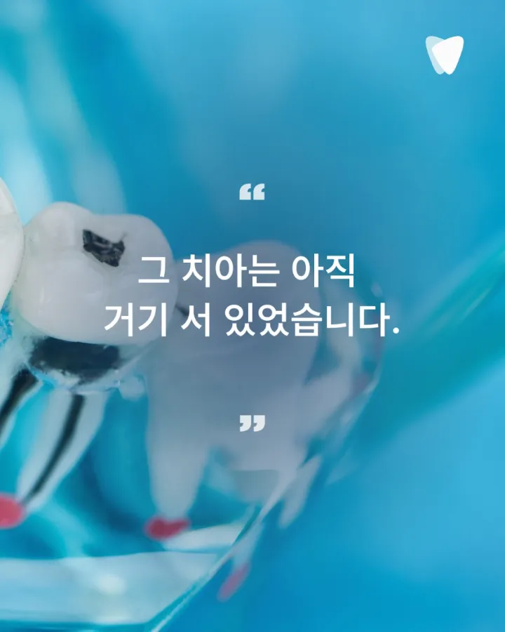 이미지 카드 · 신경치료 후 자연치아를 쉽게 빼지 않는 이유