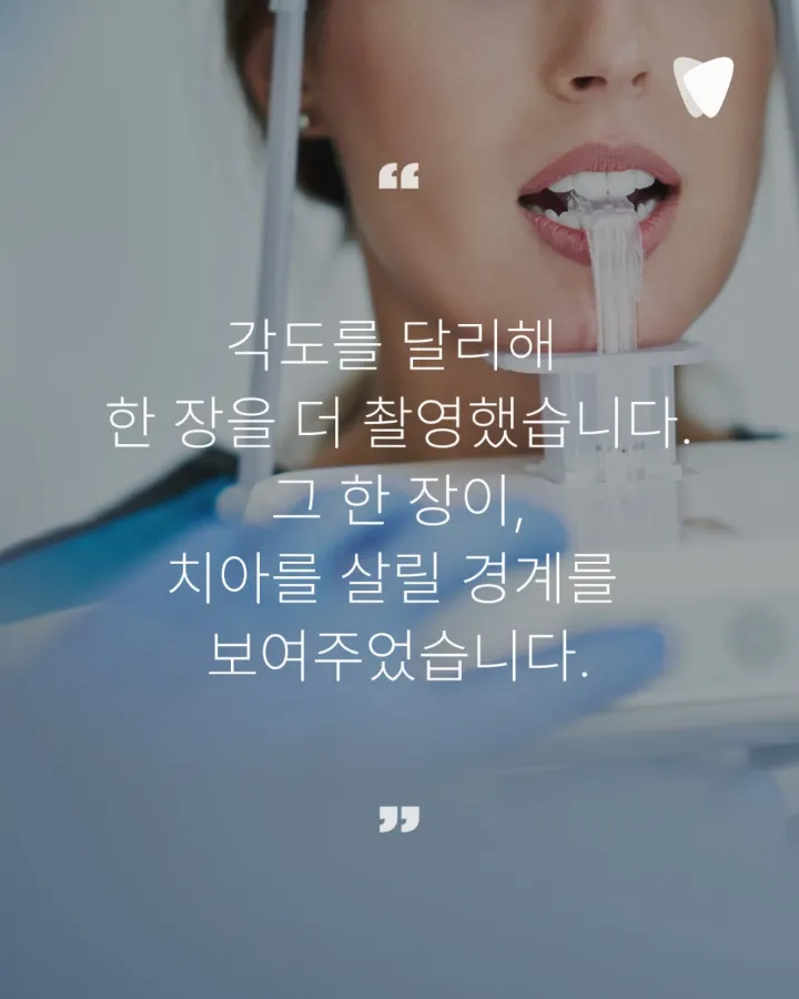이미지 카드 · 신경치료 후 자연치아를 쉽게 빼지 않는 이유