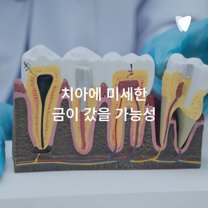 이미지 카드 · 어금니가 씹을 때 아픈 이유, 충치만 원인은 아닙니다