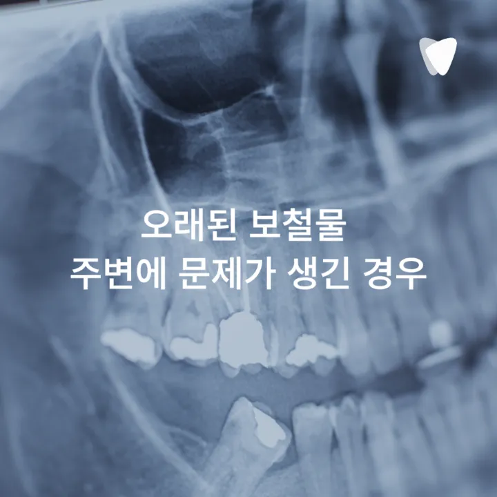 이미지 카드 · 어금니가 씹을 때 아픈 이유, 충치만 원인은 아닙니다