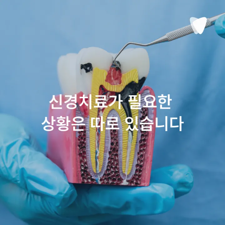 이미지 카드 · 신경치료 꼭 해야 하나요? 치아를 살리는 기준
