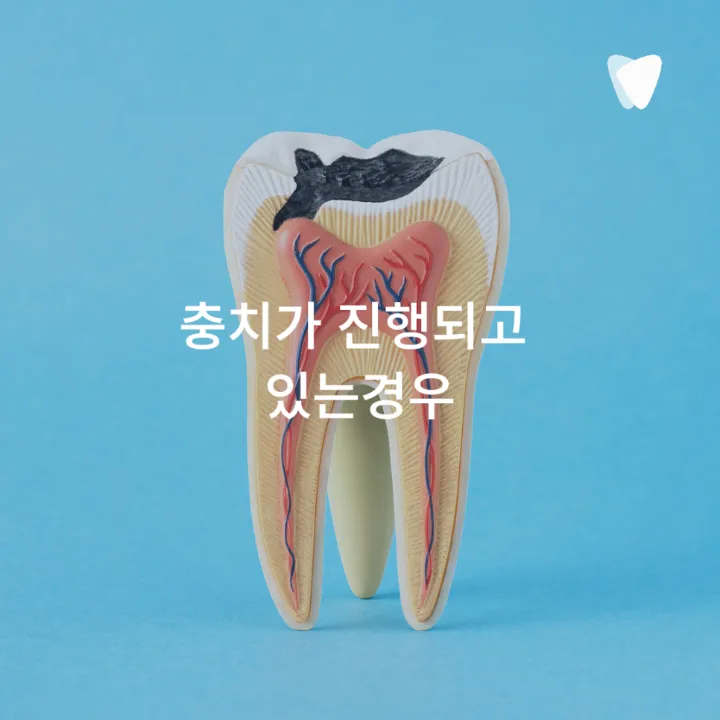 이미지 카드 · 찬물 마실 때 치아가 시린 이유, 충치 때문만은 아닙니다