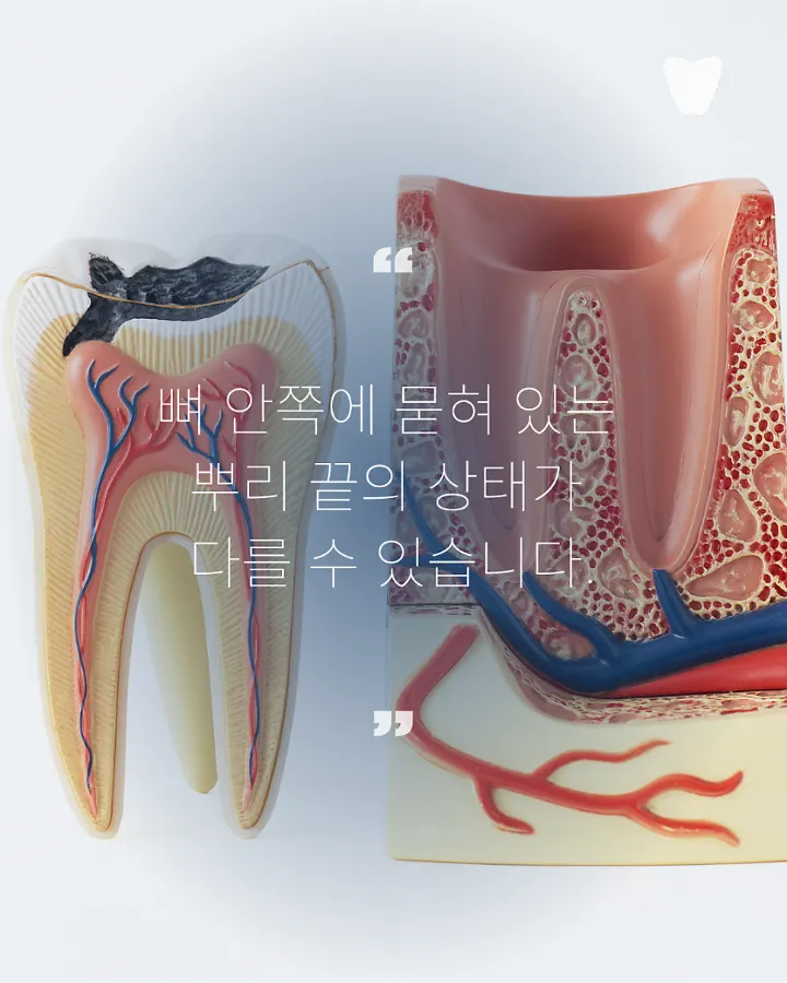 이미지 카드 · 운정 치아 뿌리 염증, 무조건 발치해야 할까요?
