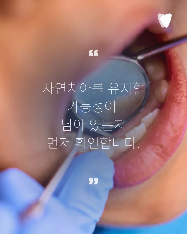 이미지 카드 · 운정 임플란트 상담 전, 자연치아를 먼저 확인하는 이유