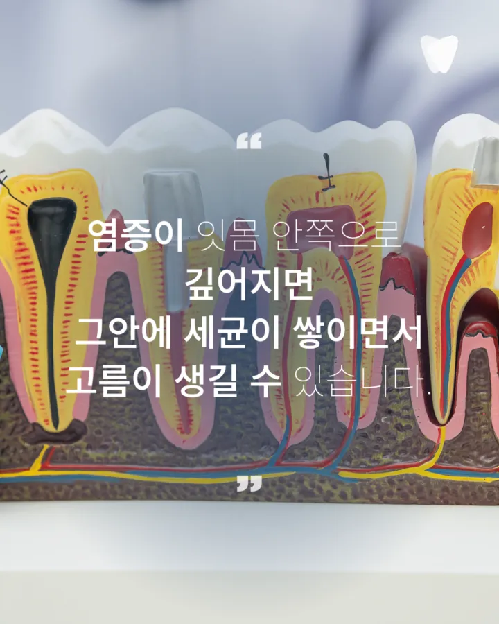 이미지 카드 · 잇몸이 붓고 고름이 날 때 먼저 의심할 수 있는 문제