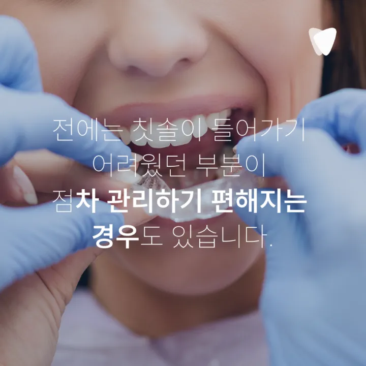 이미지 카드 · 투명교정 - 양치, 충치 관리가 더 쉬운 이유