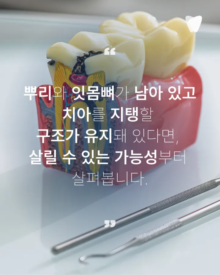 이미지 카드 · 충치가 깊어도 치아를 살릴 수 있는 경우