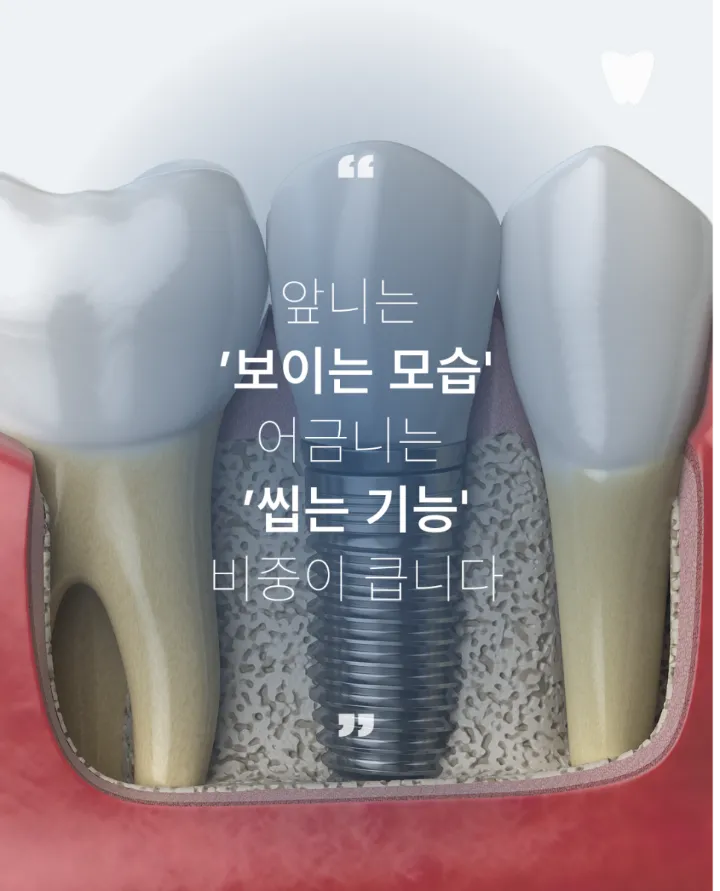 이미지 카드 · 운정 어금니 임플란트, 앞니 임플란트와 다른 점