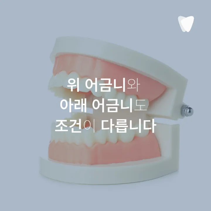 이미지 카드 · 운정 어금니 임플란트, 앞니 임플란트와 다른 점