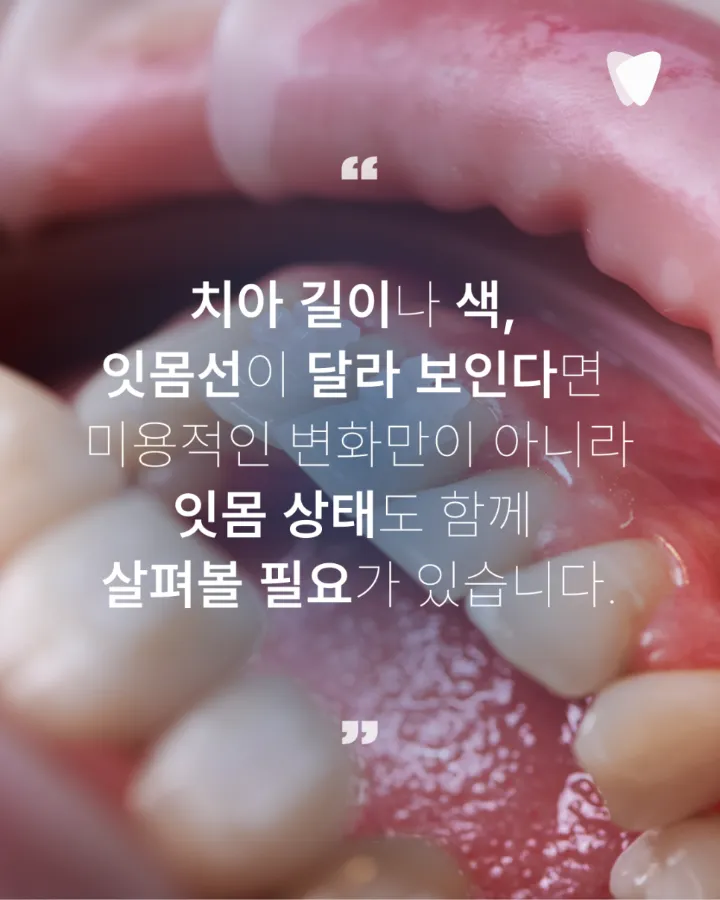 이미지 카드 · 치아가 길어 보이고 시리다면? 잇몸이 내려앉을 때 생기는 5가지 변화