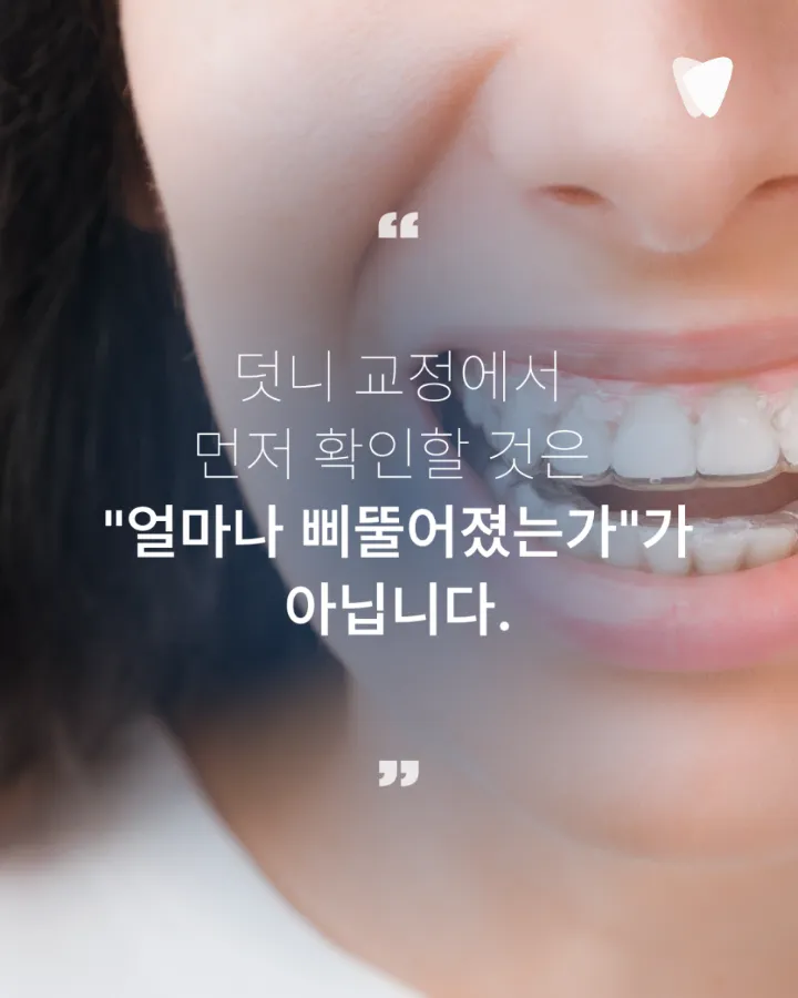 이미지 카드 · 운정 덧니 투명교정, 발치 없이 가능할까요?