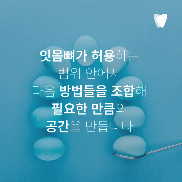 이미지 카드 · 운정 덧니 투명교정, 발치 없이 가능할까요?