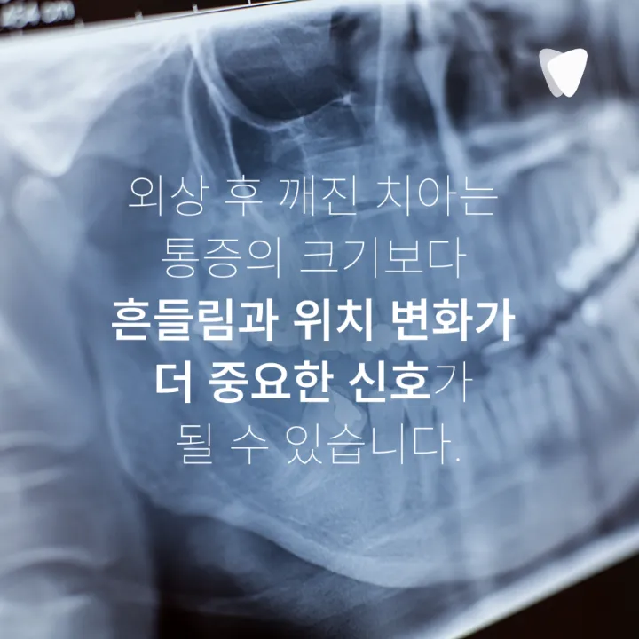 이미지 카드 · 치아가 깨졌을 때 당일 치과에 가야 할까요? 바로 확인할 6가지