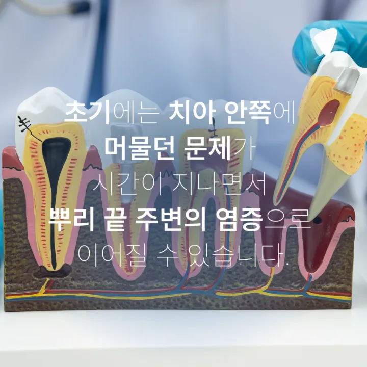 이미지 카드 · 신경치료 미루면 어떻게 될까요? 통증 없어도 치료 범위가 커지는 이유