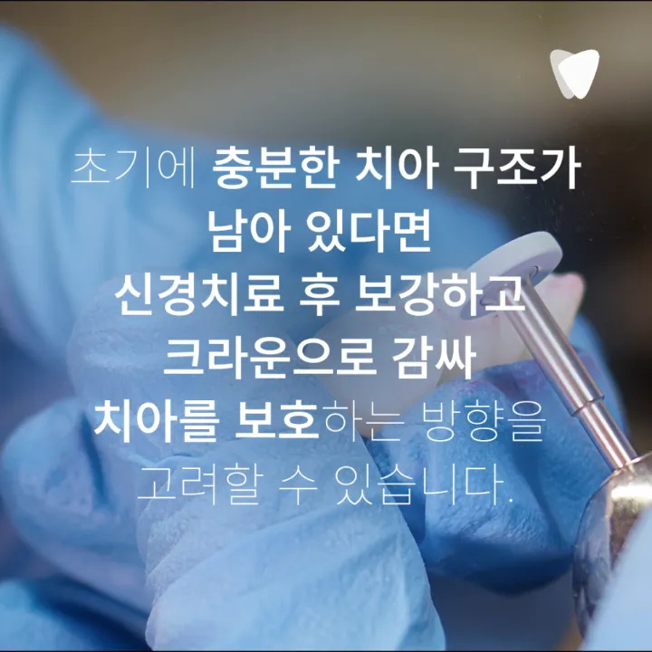 이미지 카드 · 신경치료 미루면 어떻게 될까요? 통증 없어도 치료 범위가 커지는 이유