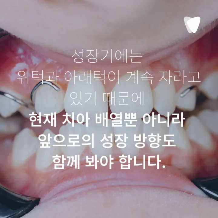 이미지 카드 · 운정 반대교합 투명교정, 가능한 경우는 따로 있습니다