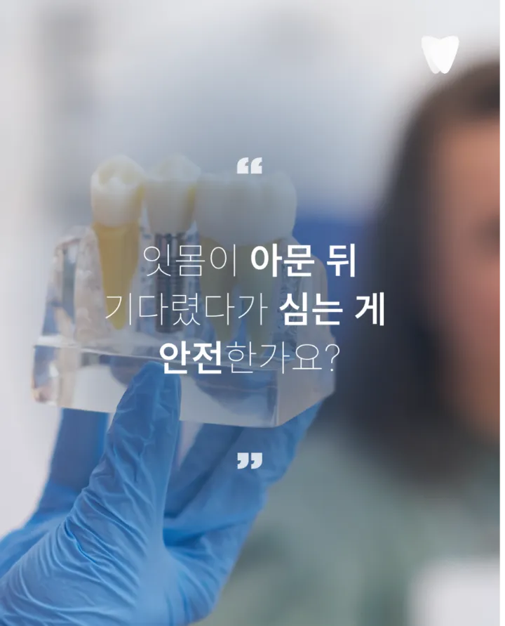 이미지 카드 · 운정 발치 후 임플란트 기간, 바로 할지 기다릴지 기준