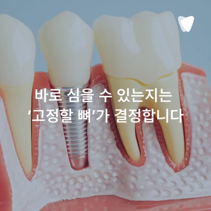 이미지 카드 · 운정 발치 후 임플란트 기간, 바로 할지 기다릴지 기준