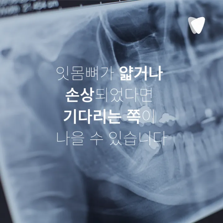 이미지 카드 · 운정 발치 후 임플란트 기간, 바로 할지 기다릴지 기준