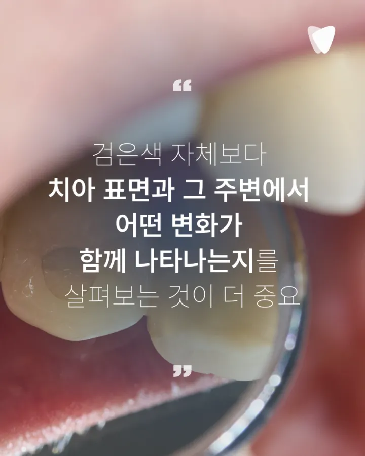이미지 카드 · 치아의 검은 점은 모두 충치일까요? 착색과 구분하는 방법