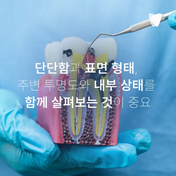 이미지 카드 · 치아의 검은 점은 모두 충치일까요? 착색과 구분하는 방법
