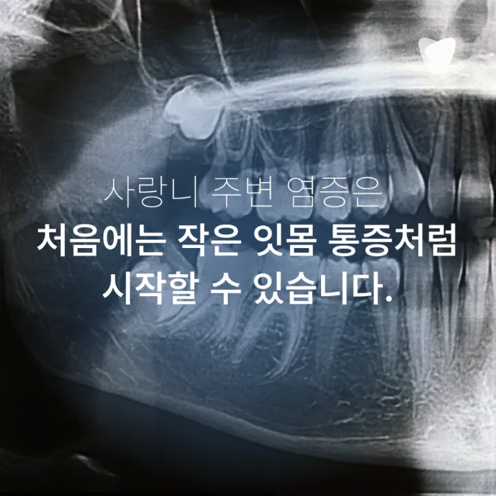 이미지 카드 · 사랑니 주변 잇몸이 붓고 입이 잘 안 벌어지는 이유