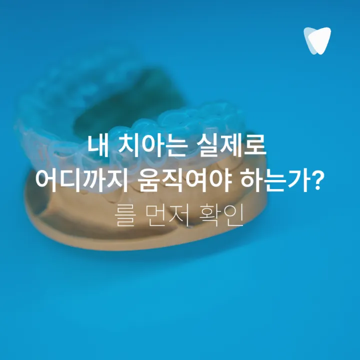 이미지 카드 · 앞니가 조금 틀어졌다면 전체교정이 꼭 필요할까요?