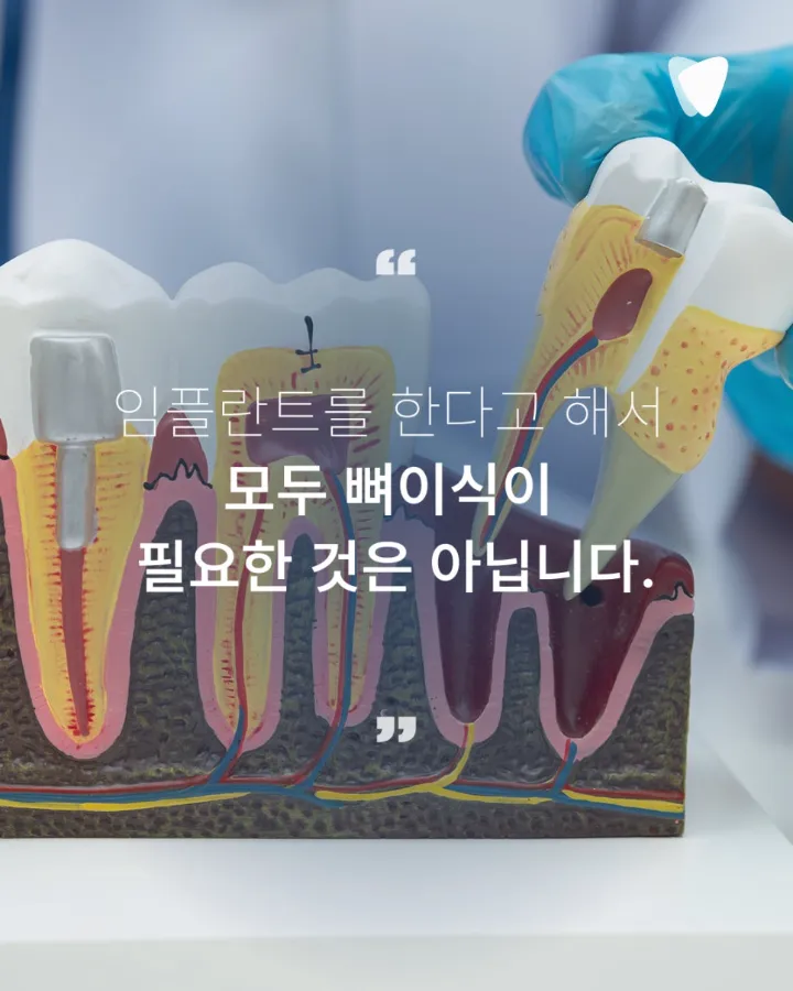 이미지 카드 · 임플란트 뼈이식, 꼭 해야 하는 경우와 아닌 경우