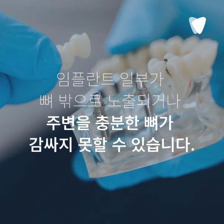 이미지 카드 · 임플란트 뼈이식, 꼭 해야 하는 경우와 아닌 경우