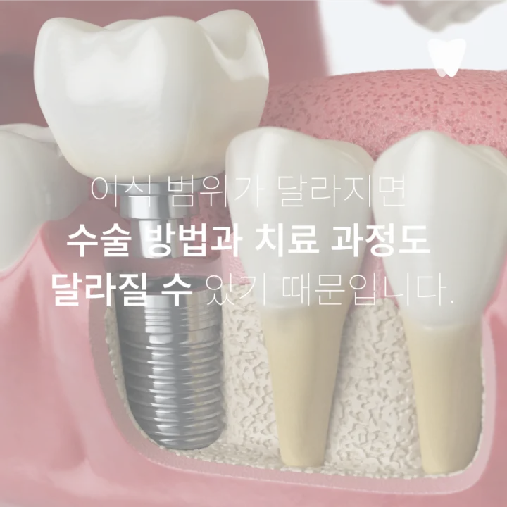 이미지 카드 · 임플란트 뼈이식, 꼭 해야 하는 경우와 아닌 경우