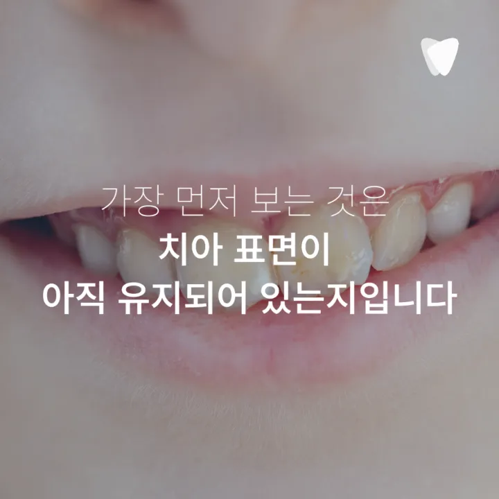 이미지 카드 · 초기 충치, 바로 치료할지 지켜볼지 결정하는 기준