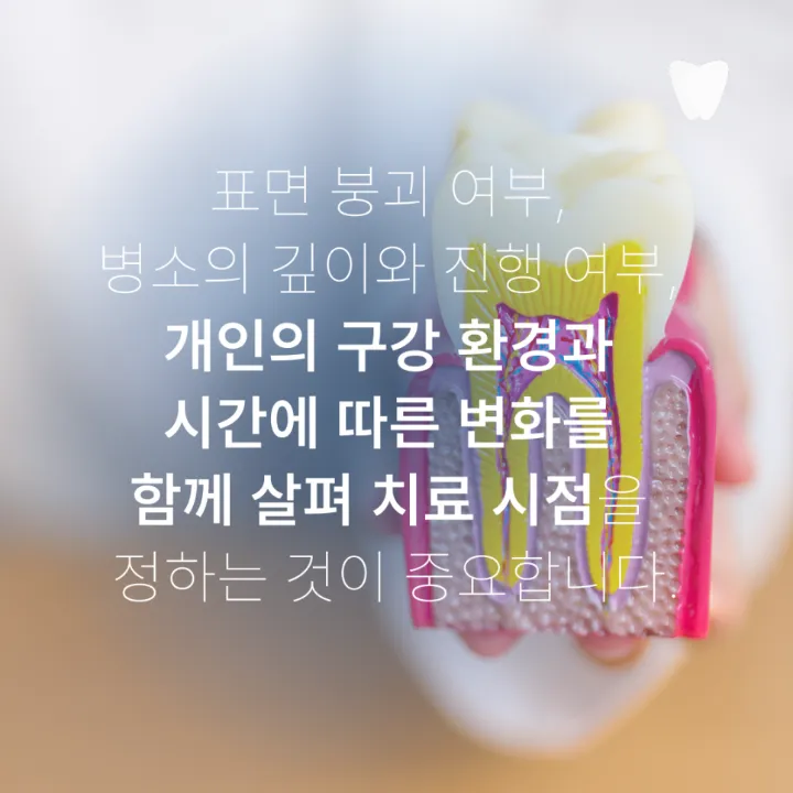 이미지 카드 · 초기 충치, 바로 치료할지 지켜볼지 결정하는 기준