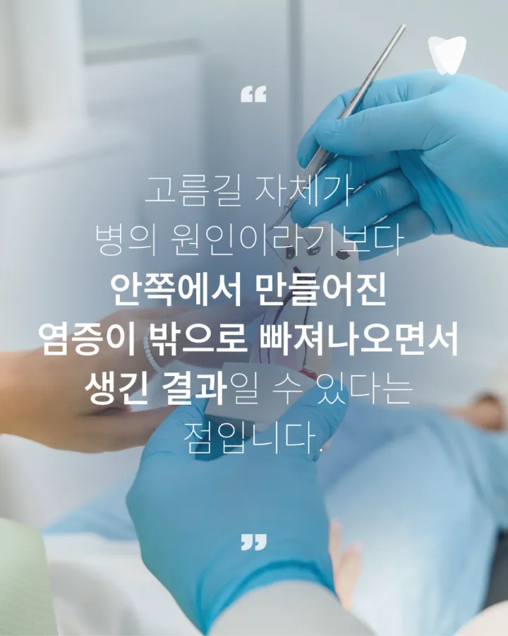 이미지 카드 · 뿌리 끝에 염증이 있는데 고름길이 반복되는 이유