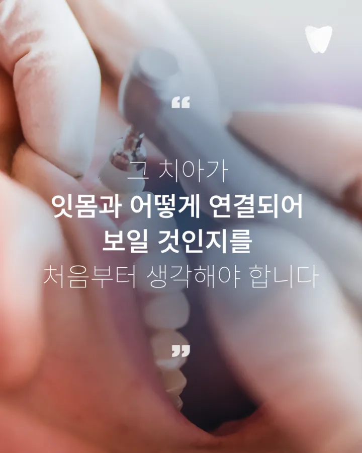 이미지 카드 · 앞니 임플란트, 잇몸 라인까지 봐야 하는 이유