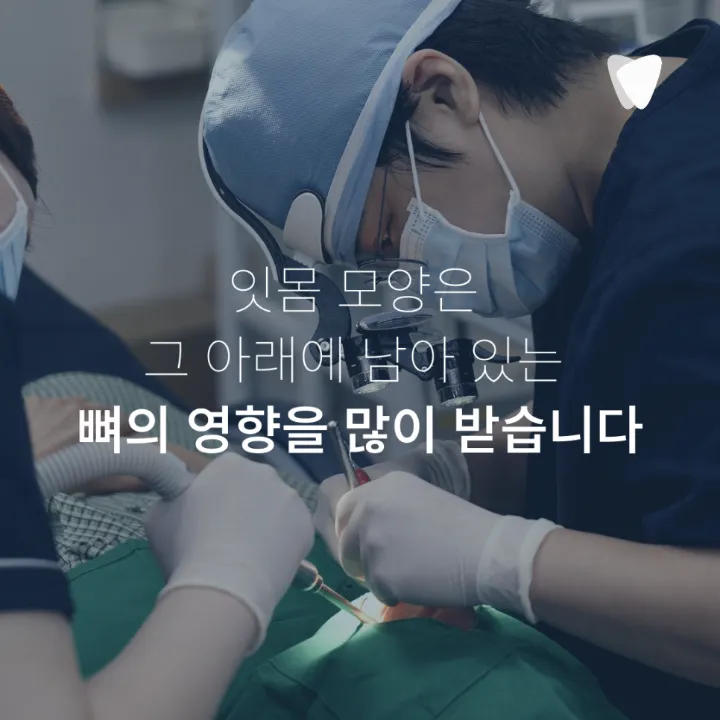 이미지 카드 · 앞니 임플란트, 잇몸 라인까지 봐야 하는 이유
