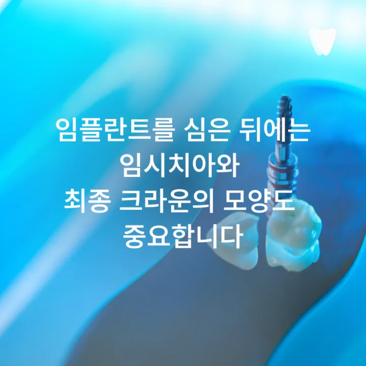 이미지 카드 · 앞니 임플란트, 잇몸 라인까지 봐야 하는 이유