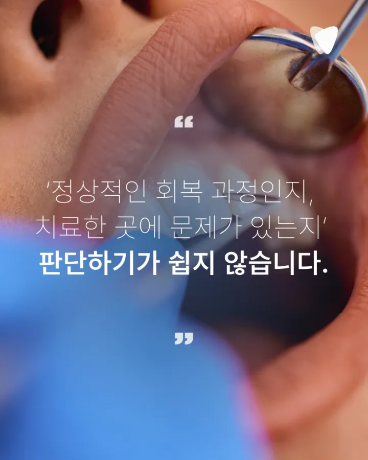 이미지 카드 · 충치 치료 후 씹을 때 아픈 이유, 언제까지 지켜봐도 될까요?