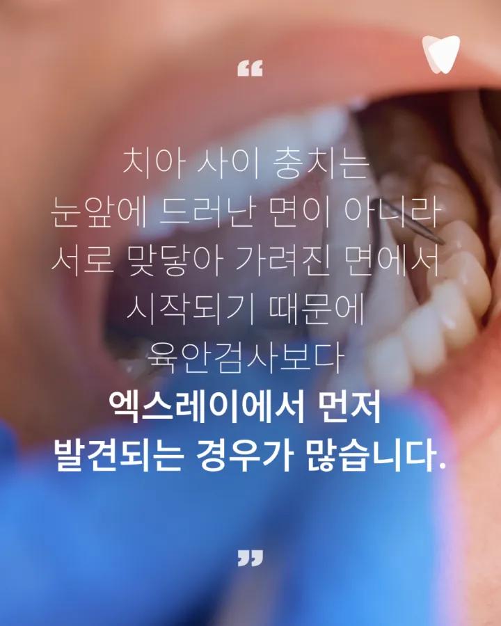 이미지 카드 · 치아 사이 충치는 왜 엑스레이에서 먼저 보일까요?