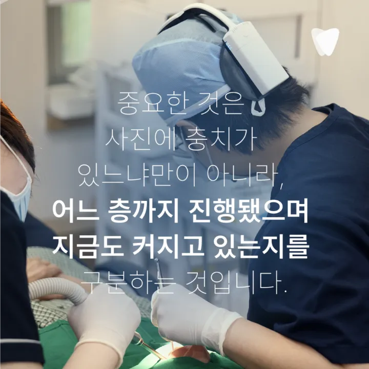 이미지 카드 · 치아 사이 충치는 왜 엑스레이에서 먼저 보일까요?
