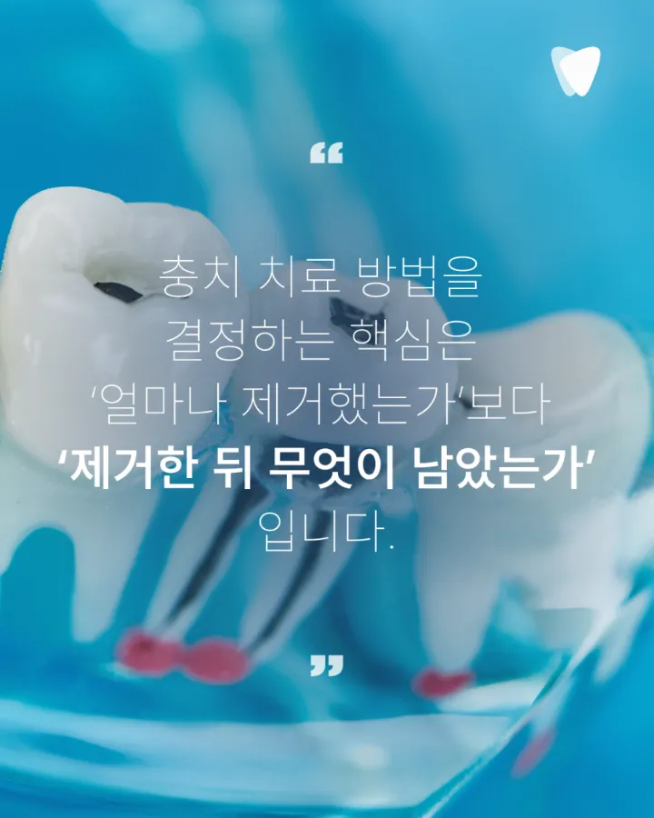 이미지 카드 · 레진·인레이·크라운, 충치 치료 방법이 달라지는 기준