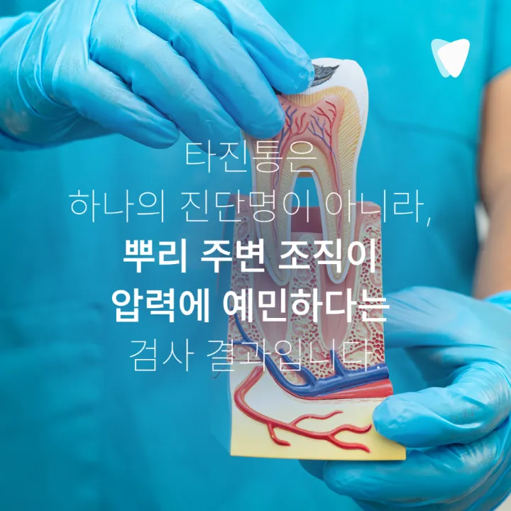 이미지 카드 · 치아를 톡톡 두드렸을 때 아픈 이유, 뿌리 주변 염증을 살피는 이유