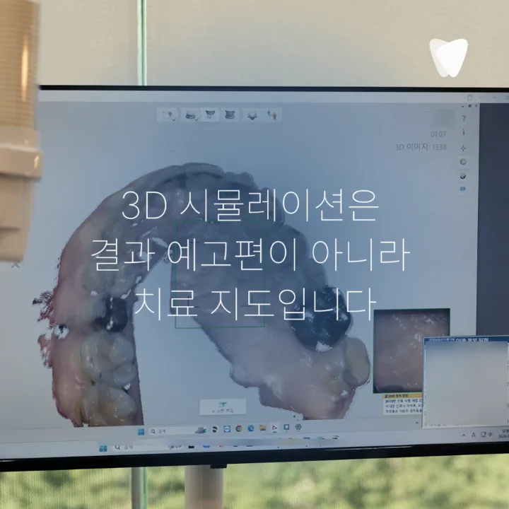 이미지 카드 · 투명교정이란? 장치 원리부터 상담·치료·유지관리까지