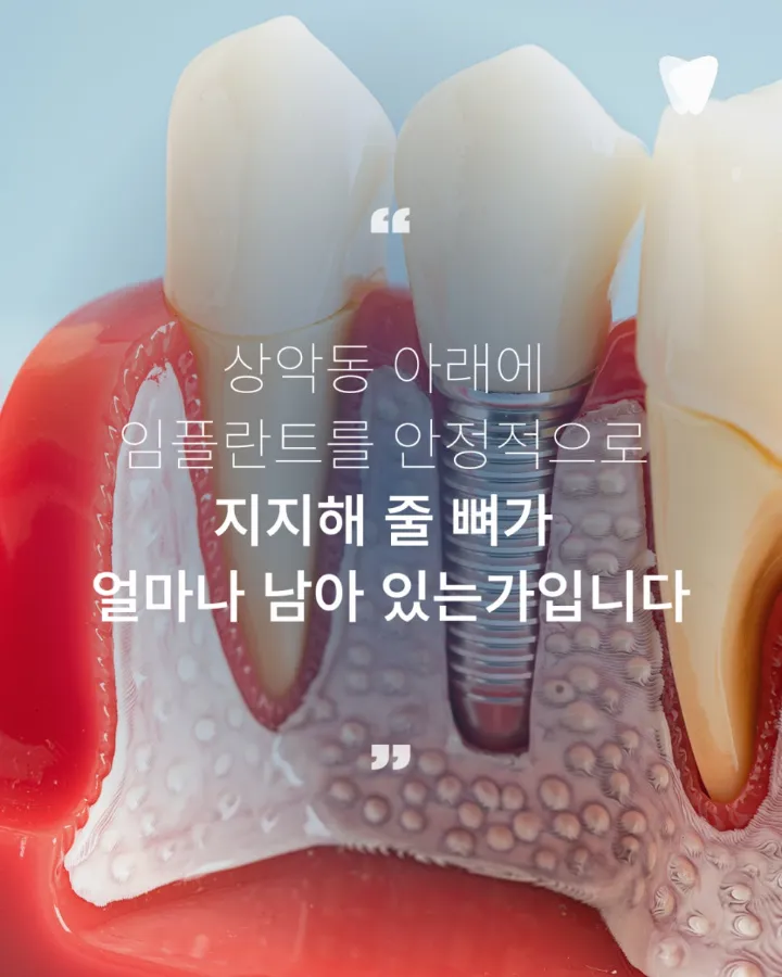 이미지 카드 · 상악동 거상술, 위 어금니 임플란트에서 필요한 경우