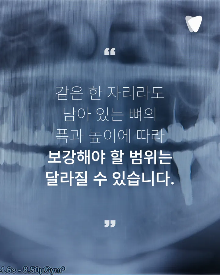 이미지 카드 · 임플란트 뼈이식 비용, 같은 뼈이식인데 왜 다를까요?