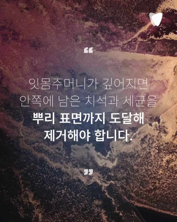 이미지 카드 · 스케일링과 잇몸치료는 어떻게 다를까요