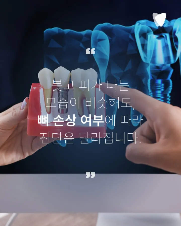 이미지 카드 · 임플란트 주위 잇몸이 붓고 피가 날 때: 점막염·주위염 구분, 연락 시점, 검사와 관리