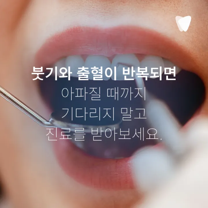 이미지 카드 · 임플란트 주위 잇몸이 붓고 피가 날 때: 점막염·주위염 구분, 연락 시점, 검사와 관리