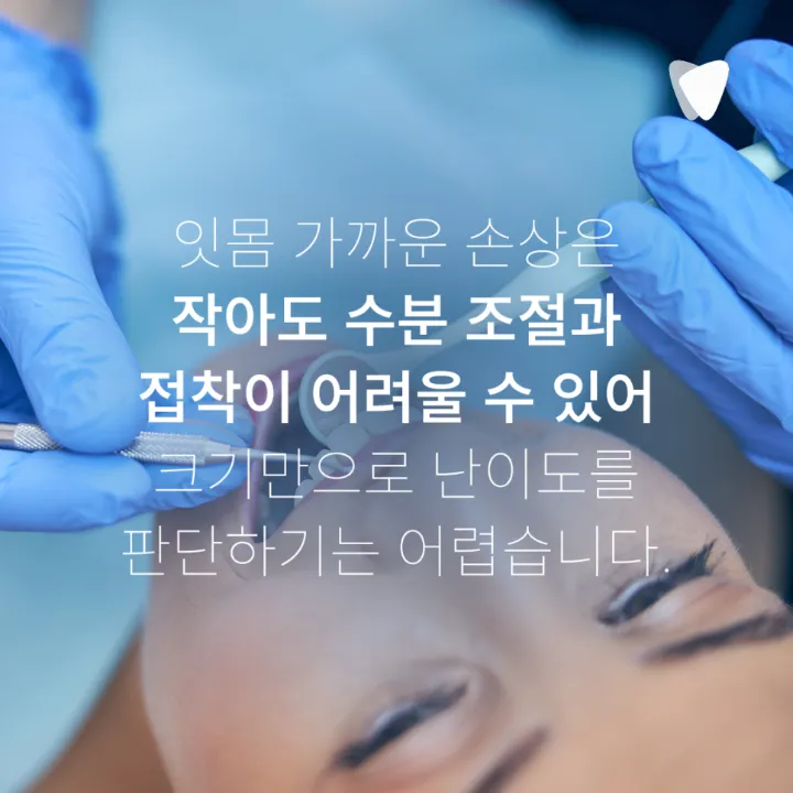 이미지 카드 · 레진 치료 비용이 치아마다 다른 이유: 치료 면·위치·접착 조건