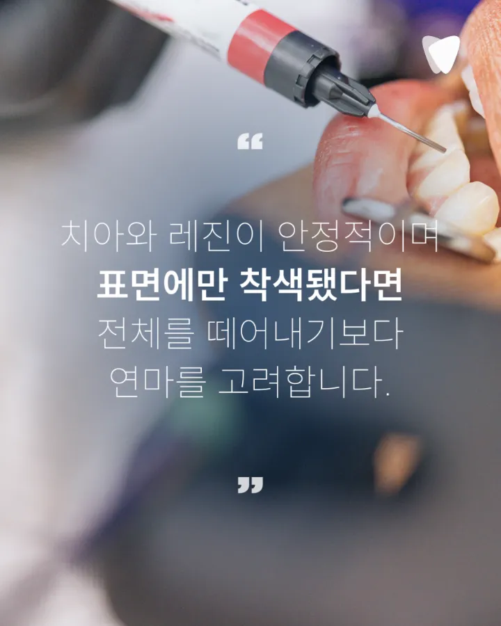 이미지 카드 · 레진 가장자리 변색, 재치료가 필요한 경우와 판단 기준