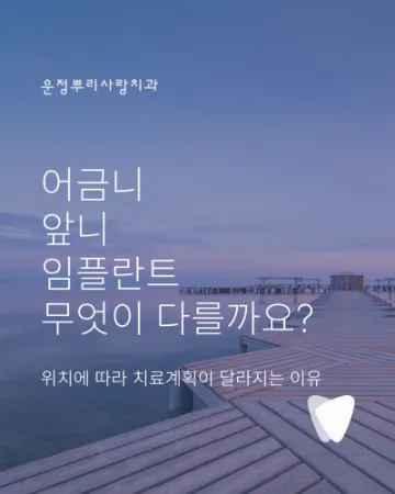 운정 어금니 임플란트, 앞니 임플란트와 다른 점